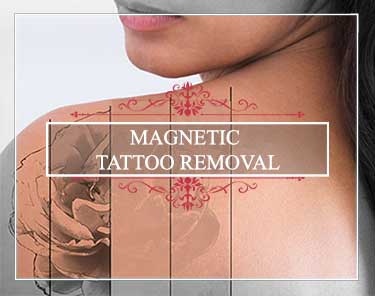ASC-Magnetic-Tattoo-Removal